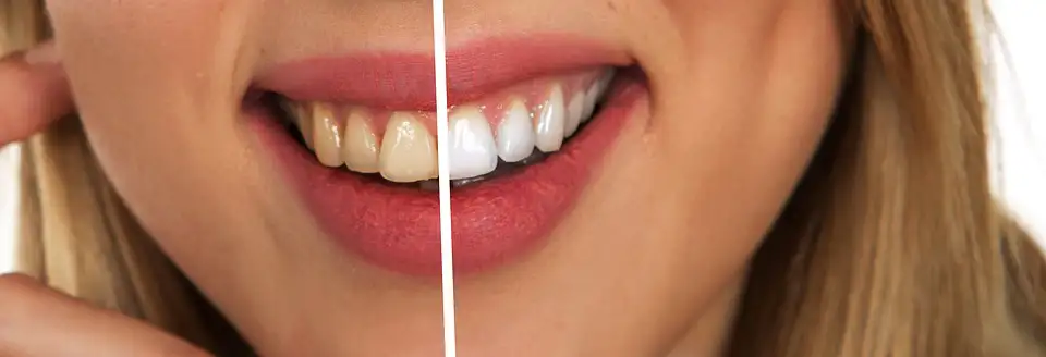 Bild von gebleachten Zähnen